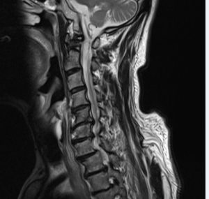 頚椎椎間板ヘルニアの原因 治療と改善例